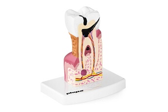 Maquette Helloshop26 Maquette anatomique de la dentition humaine molaire malade grandeur nature 14_0002397